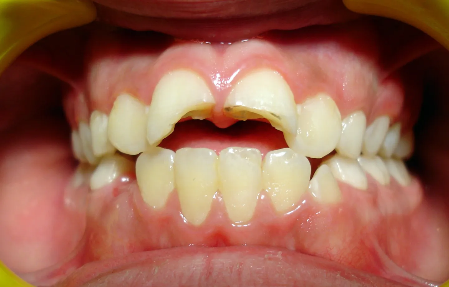 Dental restoration