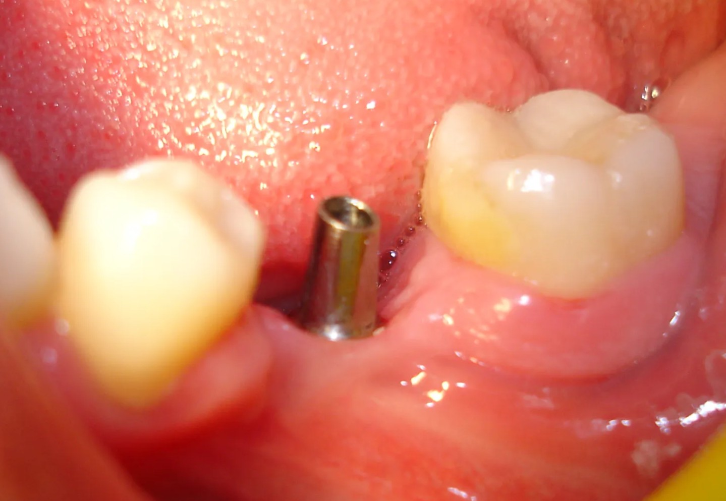 dental implant treatment