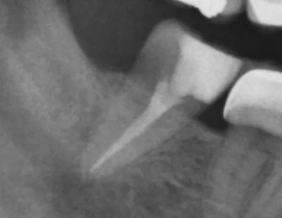 root canal terapy